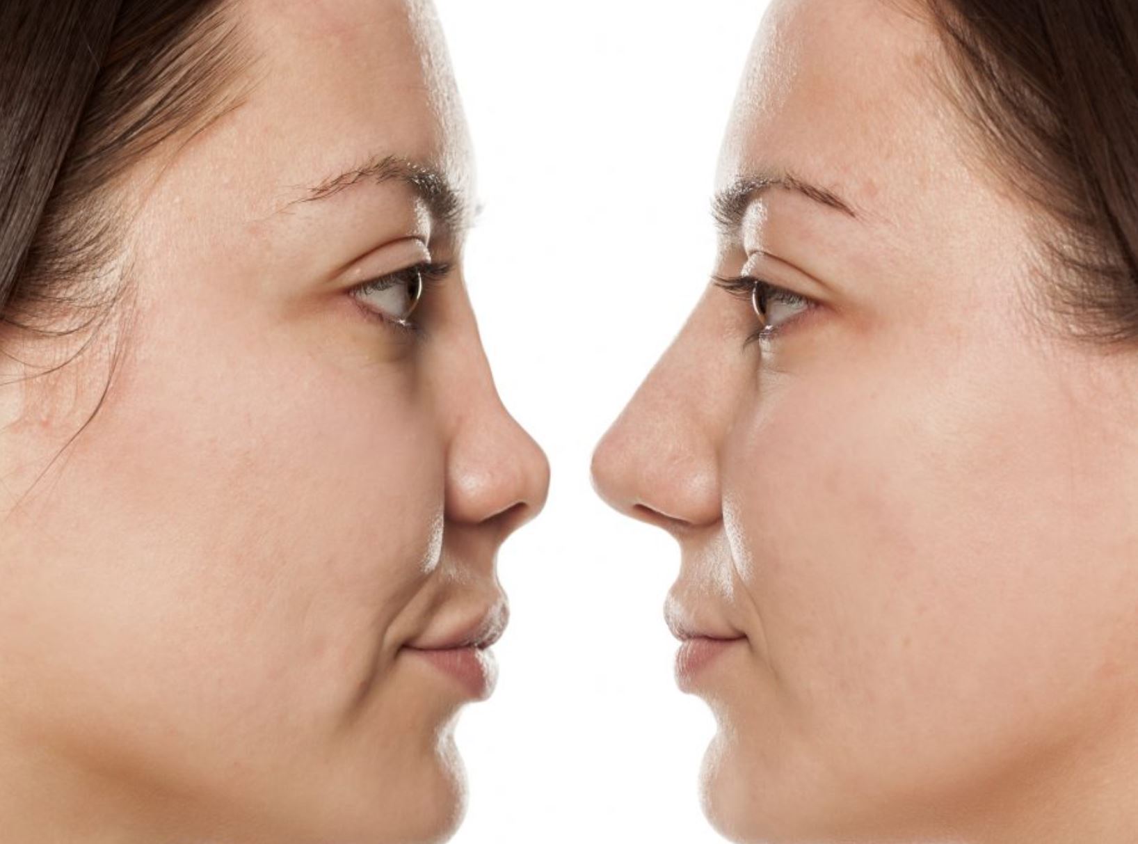 rinoplastia moderna en Quito