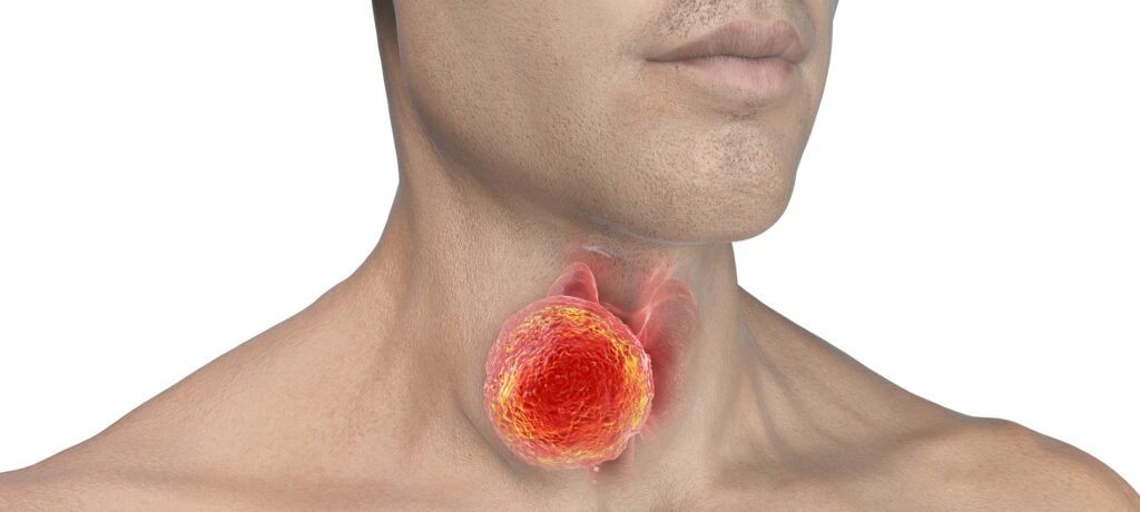 Ilustración médica de cáncer de laringe en pacientes