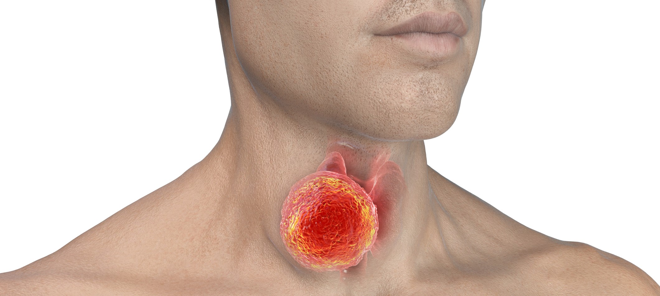 Ilustración médica de cáncer de laringe en pacientes