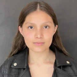 Resultados rinoplastia A Quito1