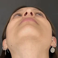 Resultados rinoplastia A Quito12