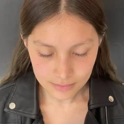 Resultados rinoplastia A Quito13