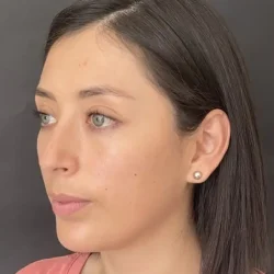 Resultados rinoplastia B Quito10