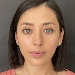 Resultados rinoplastia B Quito2