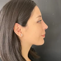 Resultados rinoplastia B Quito3
