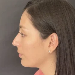 Resultados rinoplastia B Quito8
