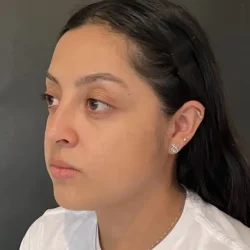 Resultados rinoplastia C Quito10