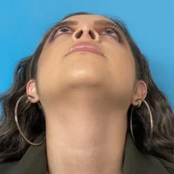 Resultados rinoplastia C Quito11