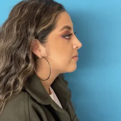 Resultados rinoplastia C Quito3