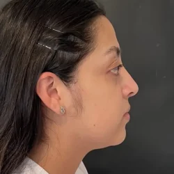 Resultados rinoplastia C Quito4