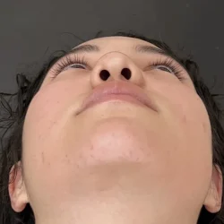 Resultados rinoplastia D Quito12