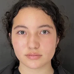 Resultados rinoplastia D Quito2
