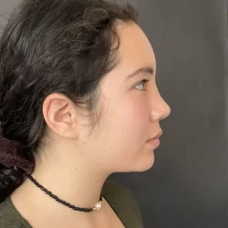 Resultados rinoplastia D Quito3