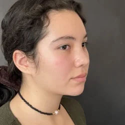 Resultados rinoplastia D Quito5
