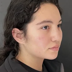Resultados rinoplastia D Quito6