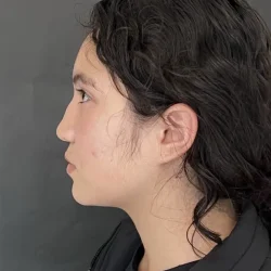 Resultados rinoplastia D Quito8