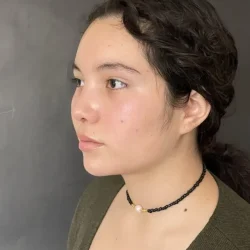 Resultados rinoplastia D Quito9