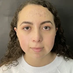 Resultados rinoplastia E Quito1
