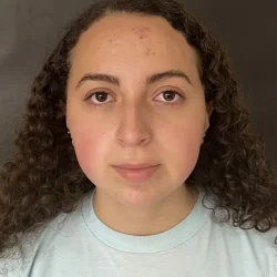 Resultados rinoplastia E Quito2