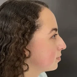 Resultados rinoplastia E Quito4