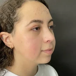 Resultados rinoplastia E Quito5