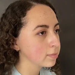Resultados rinoplastia E Quito6