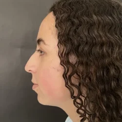 Resultados rinoplastia E Quito8