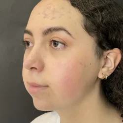 Resultados rinoplastia E Quito9