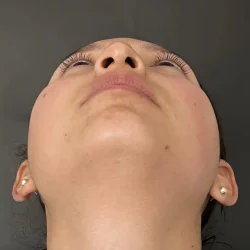 Resultados rinoplastia F Quito10