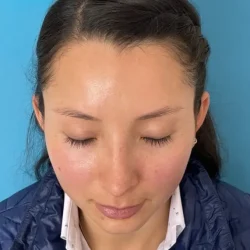 Resultados rinoplastia F Quito11
