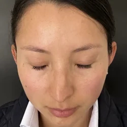 Resultados rinoplastia F Quito12