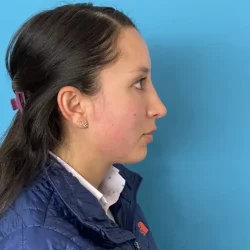 Resultados rinoplastia F Quito3