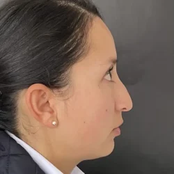 Resultados rinoplastia F Quito4