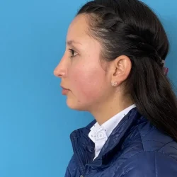 Resultados rinoplastia F Quito5