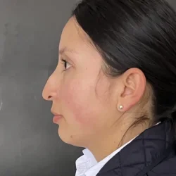 Resultados rinoplastia F Quito6