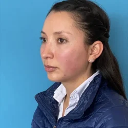 Resultados rinoplastia F Quito7
