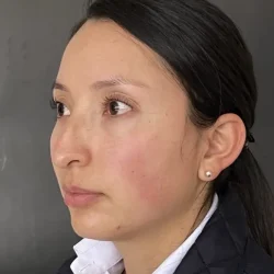 Resultados rinoplastia F Quito8