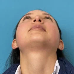 Resultados rinoplastia F Quito9