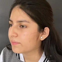 Resultados rinoplastia G Quito10