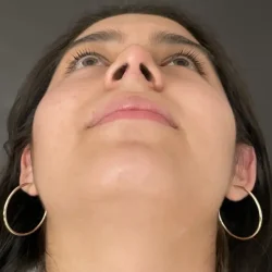 Resultados rinoplastia G Quito11