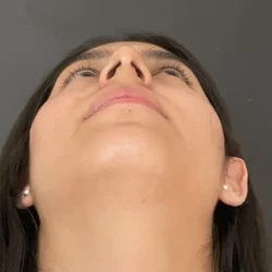 Resultados rinoplastia G Quito12