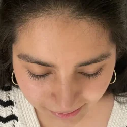 Resultados rinoplastia G Quito13