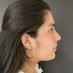 Resultados rinoplastia G Quito3