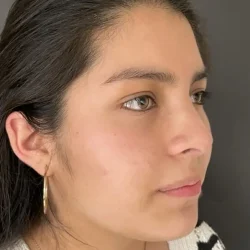 Resultados rinoplastia G Quito5