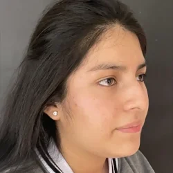 Resultados rinoplastia G Quito6