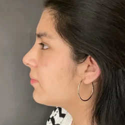 Resultados rinoplastia G Quito7
