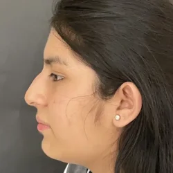 Resultados rinoplastia G Quito8
