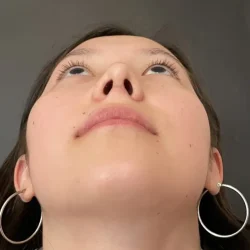 Resultados rinoplastia I Quito11