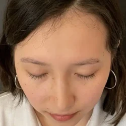 Resultados rinoplastia I Quito13