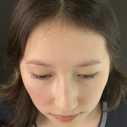 Resultados rinoplastia I Quito14